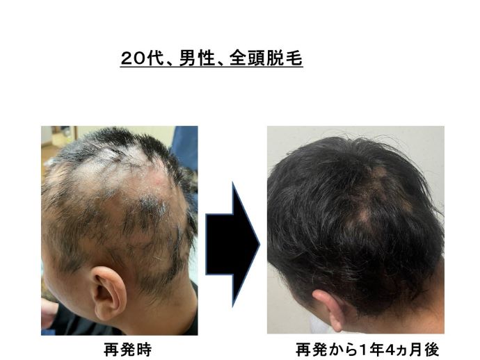 円形脱毛症　病院